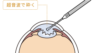 超音波で砕く